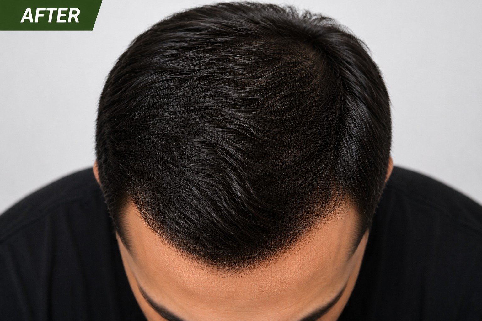 After RegrowthX Minoxidil Regrowth